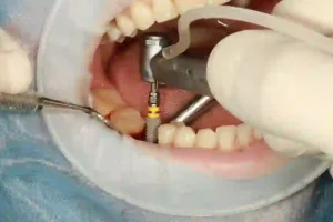 Single Dental Implants