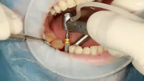 Single Dental Implants